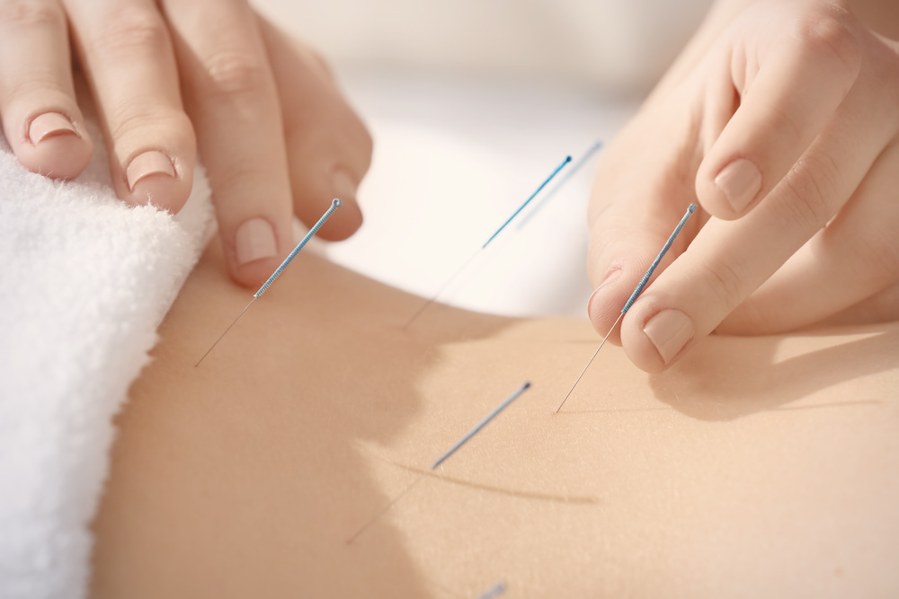 Acupuncture in Courtice and Peterborough.