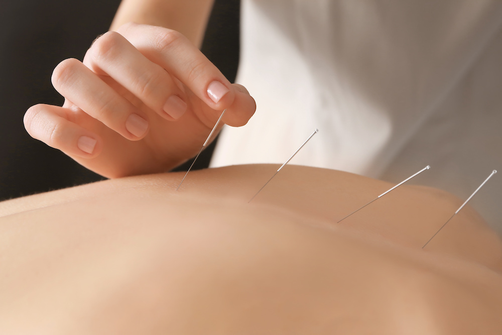 Acupuncture in Newcastle, ON and Bowmanville, ON